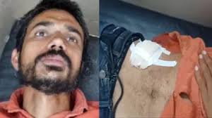 युवक ने खुद ही कर ल‍िया अपना ऑपरेशन, YouTube देख लगाए 11 टांके