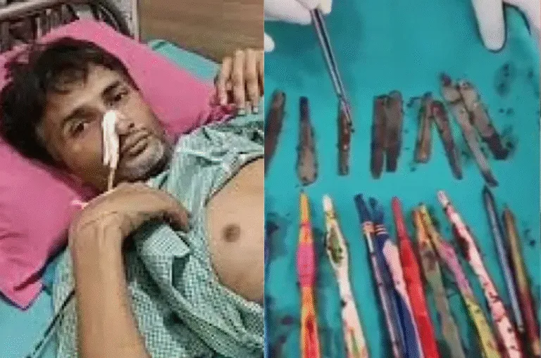 यूपी से एक हैरान कर देने वाला मामला: युवक के पेट से निकले 29 चम्मच, 19 टूथब्रश और 2 पेन